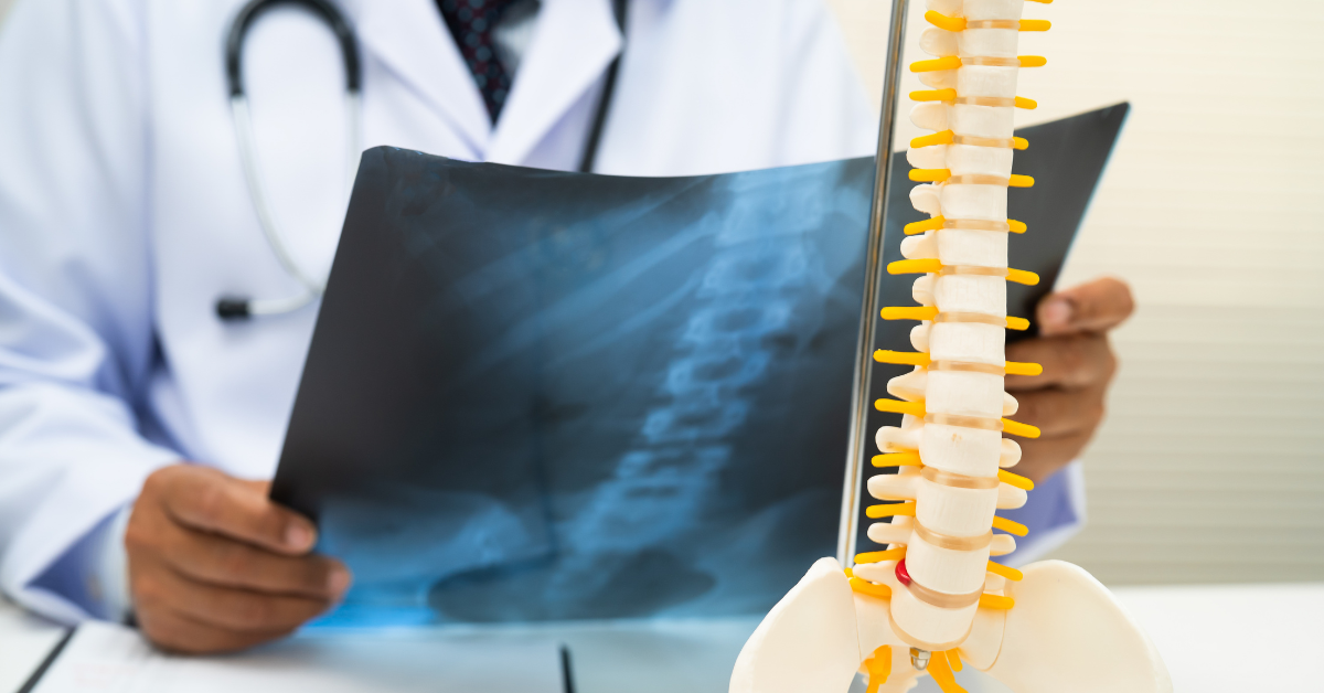 Can Physiotherapy Prevent Spine Surgery