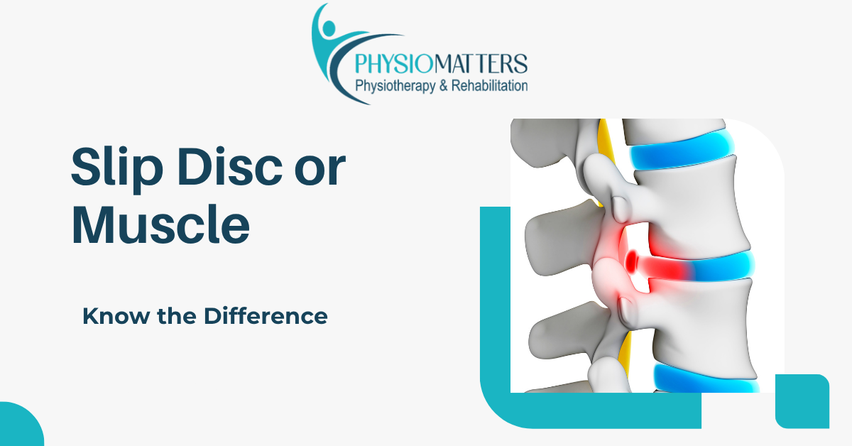Slip Disc vs Muscle Spasm